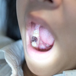 An up-close view of a stainless steel crown located in the lower arch of a child’s mouth