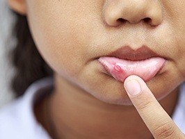 Child with cut lip